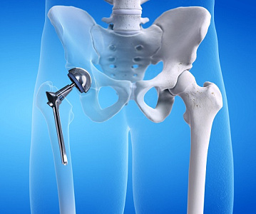 Движение без боли: эндопротезирование тазобедренного сустава